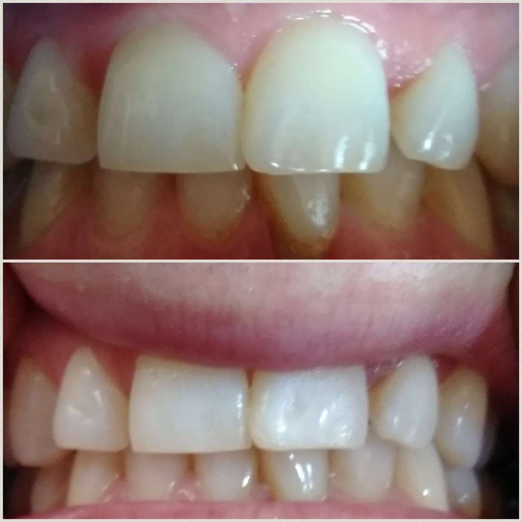 Yevonne’s laser teeth whitening LLC | 4933 S Carson St APT 212, Aurora, CO 80015, USA | Phone: (720) 629-9030