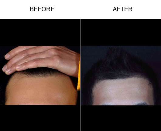 Melbourne Hair Restoration Center | 1705 Berglund Ln, Melbourne, FL 32940, USA | Phone: (321) 872-0511