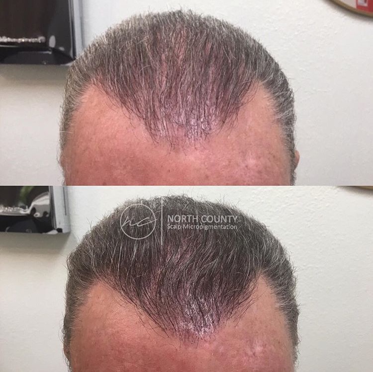 North County Scalp Micropigmentation | 1172, 1822 Marron Rd, Carlsbad, CA 92008, USA | Phone: (760) 805-6801