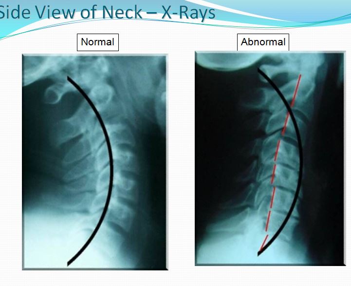 Advanced Spine and Posture | 6592 N Decatur Blvd, Las Vegas, NV 89131, USA | Phone: (702) 396-4993