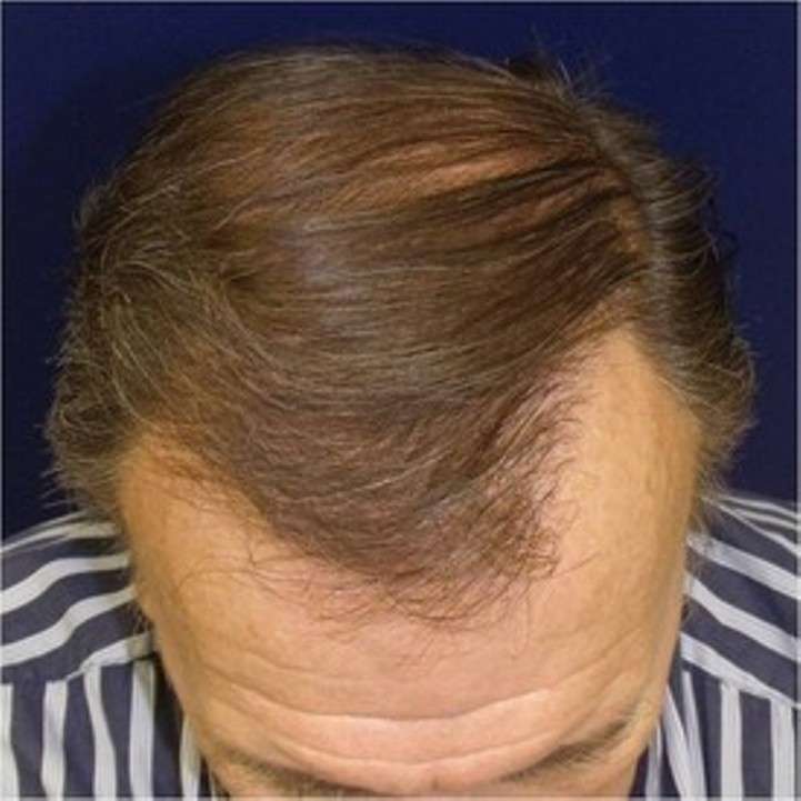 Chesapeake Hair Restoration - Hair Transplants in Baltimore, Mar | 10807 Falls Rd #101, Lutherville-Timonium, MD 21093, USA | Phone: (410) 753-8600