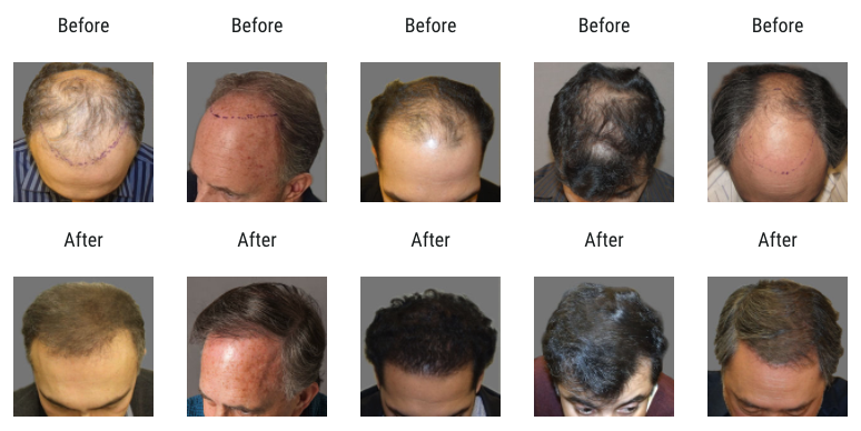 Capri Hair Restoration | 2813 Bristol Pike, Bensalem, PA 19020, USA | Phone: (877) 602-2774