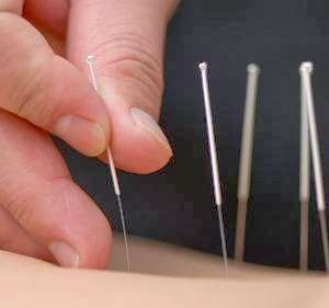 Talia Malka Acupuncture | 4026 Woodruff Rd, Lafayette Hill, PA 19444, USA | Phone: (610) 825-8767