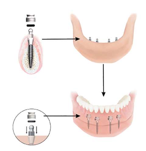 Dental Implant Solutions Oswego, IL | 1301 Orchard Rd #1, Oswego, IL 60543, USA | Phone: (630) 449-3734