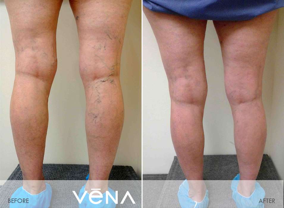 Vena Vascular Pasadena | 333 N Hill Ave, Pasadena, CA 91106, USA | Phone: (626) 449-9922