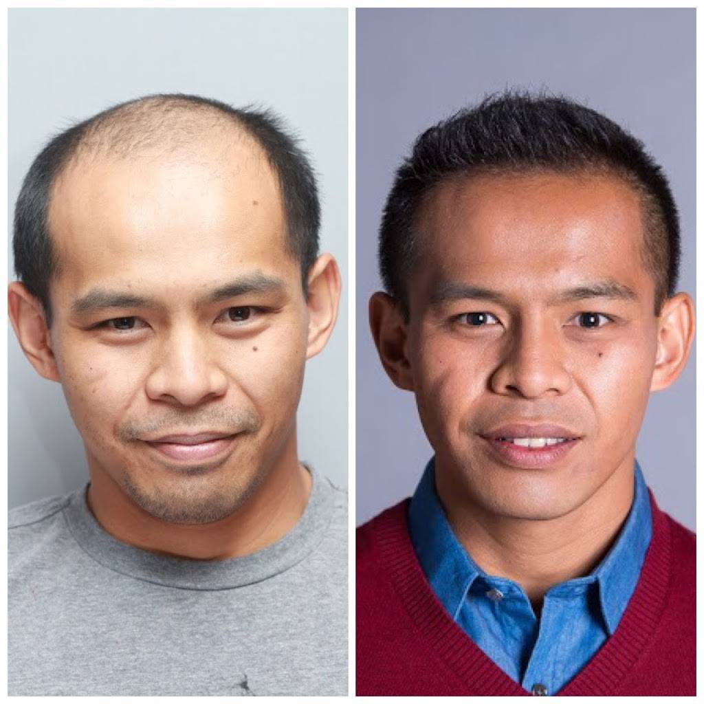 Bosley - Hair Restoration & Transplant | 1860 Howe Ave #230, Sacramento, CA 95825 | Phone: (916) 209-0774