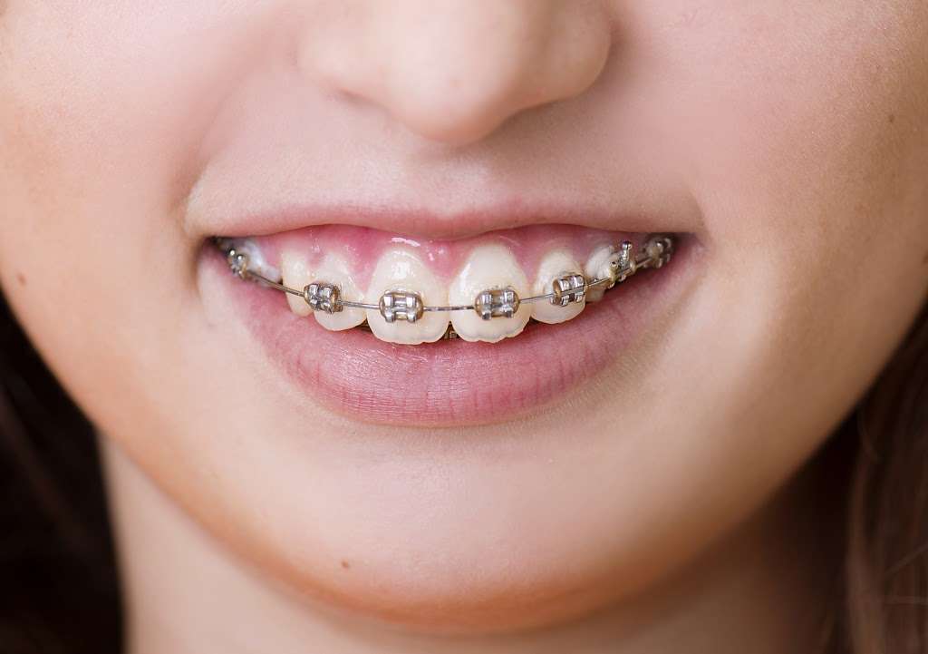 Cypress Orthodontic Pediatric Dentistry | 14315 Cypress Rosehill Rd, 100, Cypress, TX 77429 | Phone: (281) 256-8585