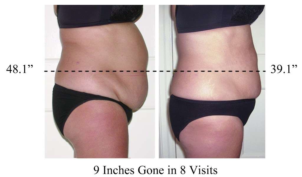 Los Angeles Laser Like Lipo | 100 W Imperial Ave n, El Segundo, CA 90245, USA | Phone: (424) 262-4871