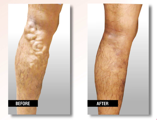 USA Vein Clinics | 30-33 Steinway St, Astoria, NY 11103, USA | Phone: (718) 874-9778