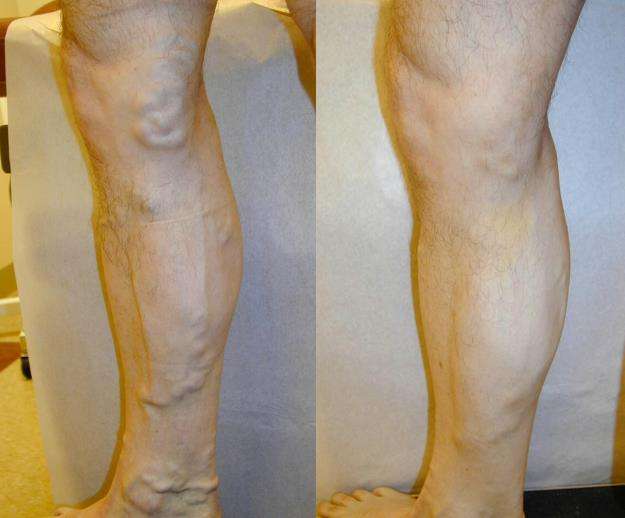 Clear Vein Center | 1247 Milwaukee Ave Suite 205, Glenview, IL 60025 | Phone: (847) 813-5404