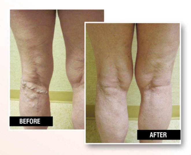 USA Vein Clinics | 2369b Central Park Ave, Yonkers, NY 10710, USA | Phone: (347) 535-4150