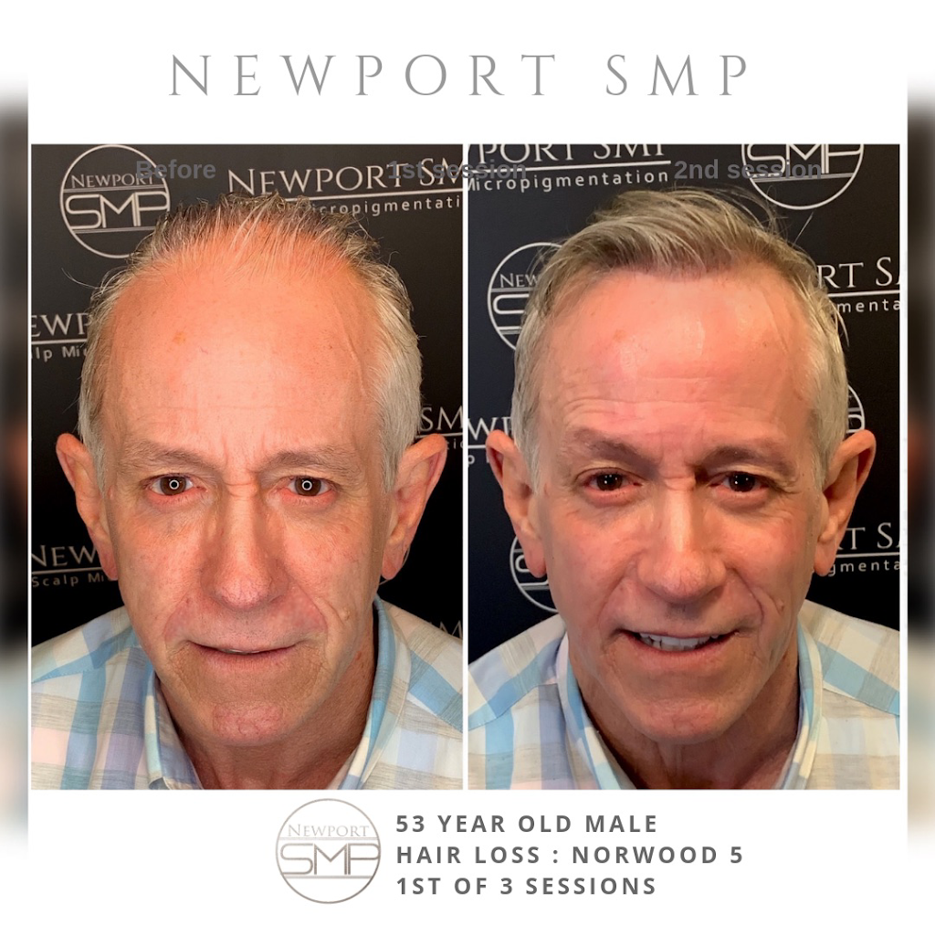 Newport Beach SMP Hair Restoration | 4120 Birch St #102, Newport Beach, CA 92660, USA | Phone: (949) 520-2525