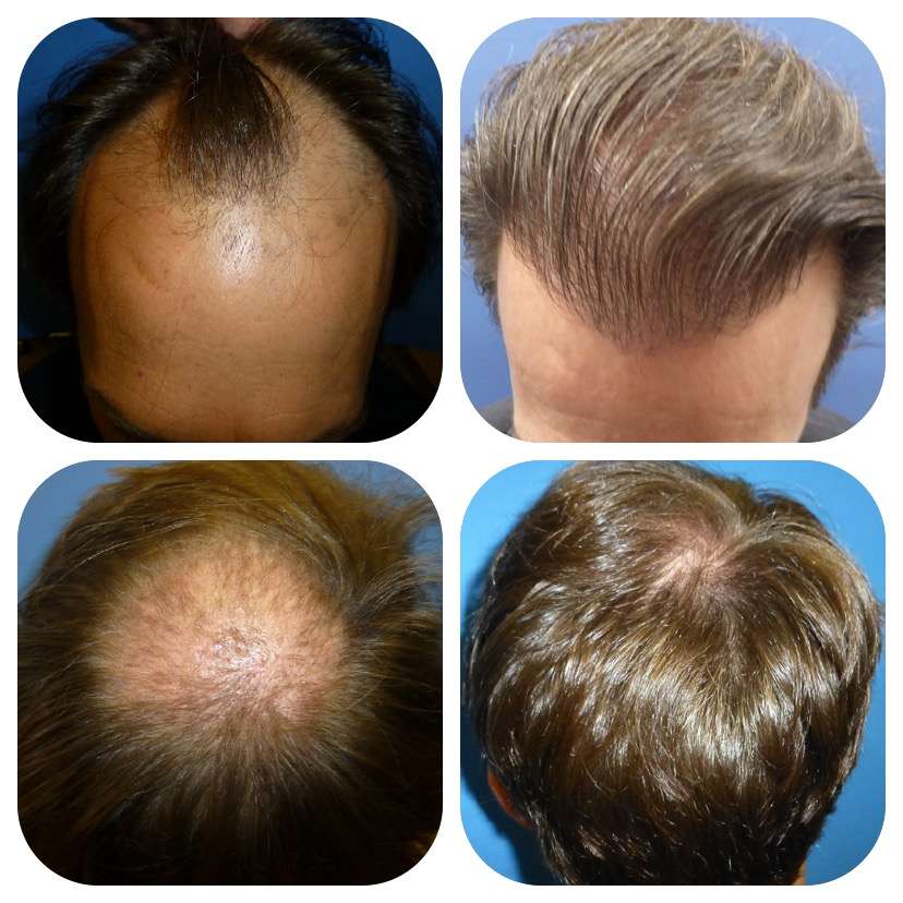 Meshkin Medical - Cosmetic Hair Restoration and Hair Transplant  | 912 W Glenoaks Blvd, Glendale, CA 91202, USA | Phone: (800) 246-8424