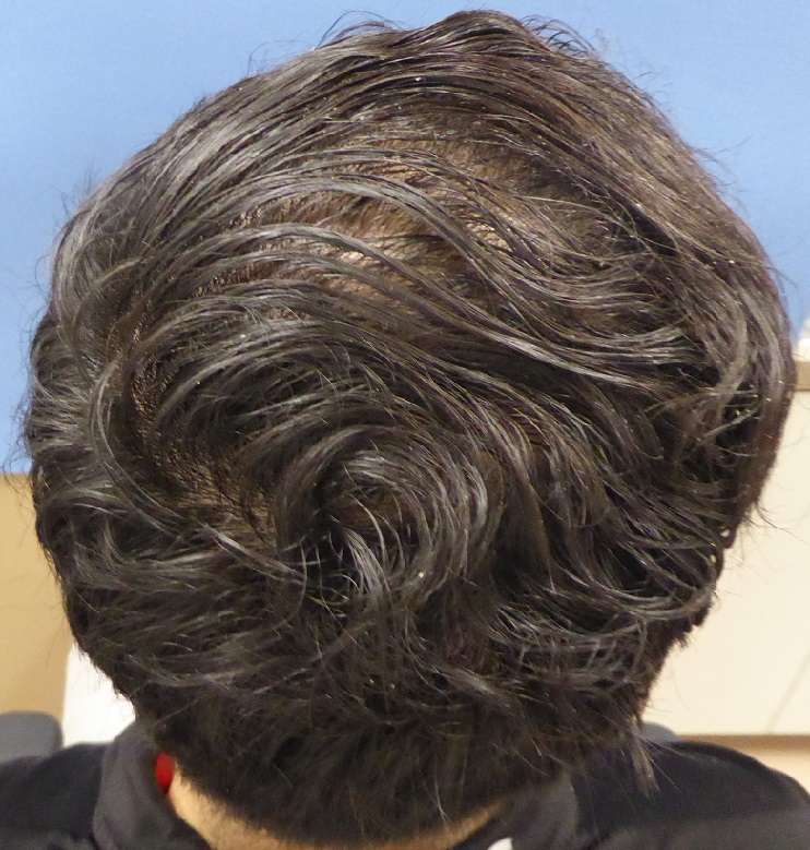 Meshkin Medical - Cosmetic Hair Restoration and Hair Transplant  | 912 W Glenoaks Blvd, Glendale, CA 91202, USA | Phone: (800) 246-8424