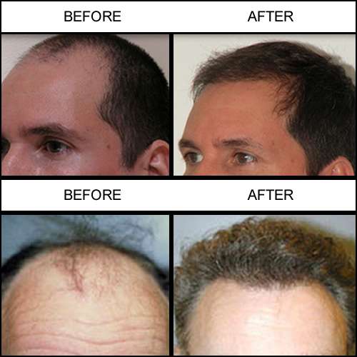 Melbourne Hair Restoration Center | 1705 Berglund Ln, Melbourne, FL 32940, USA | Phone: (321) 872-0511