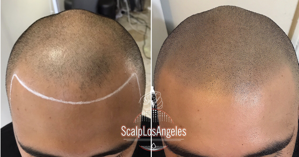 Scalp Los Angeles | 15213 Cantara St, Van Nuys, CA 91402, USA | Phone: (833) 424-7448