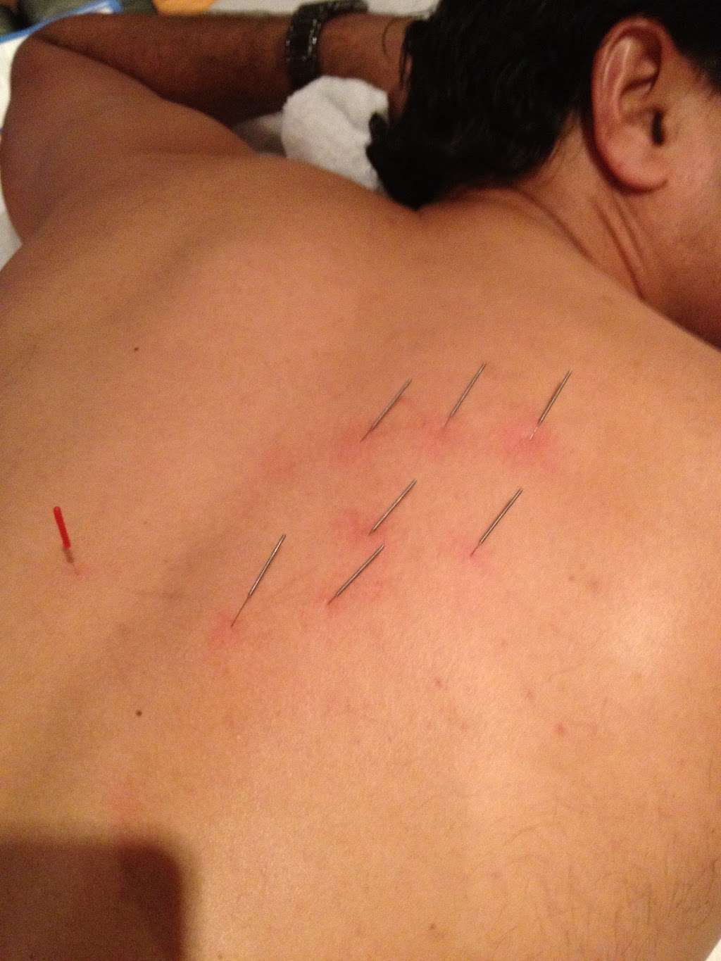 The Root Cause Acupuncture | 1900 S Olive Ave, West Palm Beach, FL 33401, USA | Phone: (817) 681-3924