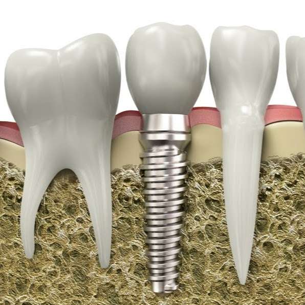 Implant Dental Arts | 1107 Nelson St Suite 201, Rockville, MD 20850, USA | Phone: (301) 424-2036
