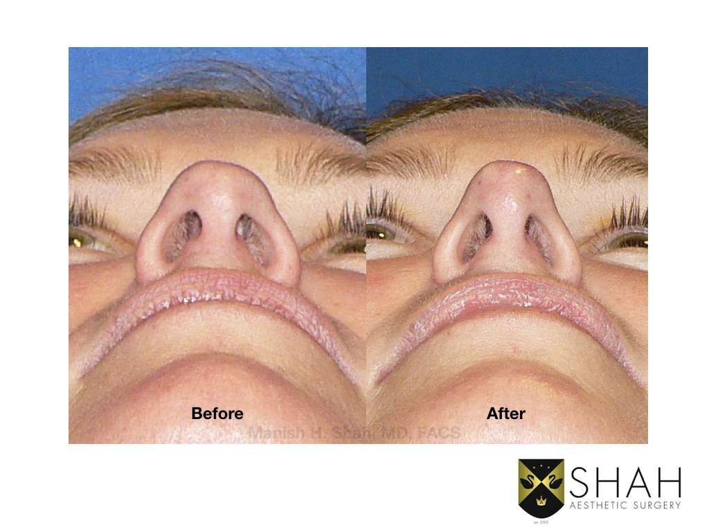 Shah Aesthetic Surgery | 101 University Blvd Suite #220, Denver, CO 80206, USA | Phone: (720) 575-1600