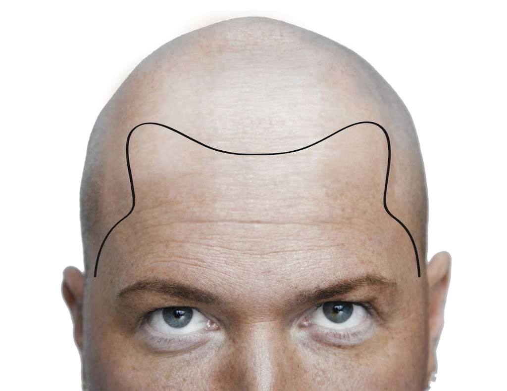 Scalp Micropigmentation • Hair Tattoo Salon | 211 TX-121 Suite #120-A, Lewisville, TX 75067, USA | Phone: (972) 839-1999