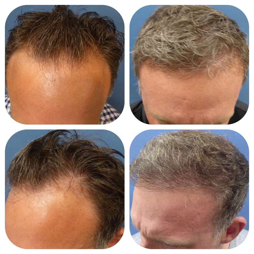 Meshkin Medical - Cosmetic Hair Restoration and Hair Transplant  | 912 W Glenoaks Blvd, Glendale, CA 91202, USA | Phone: (800) 246-8424