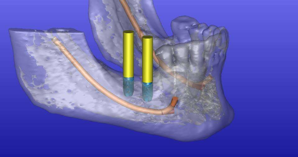 Seven Hills Dental & Implant Center | 456 W Northwest Hwy #200, Palatine, IL 60067, USA | Phone: (847) 701-8733