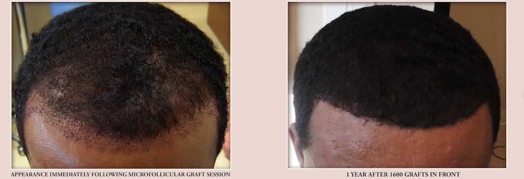 Advanced Hair Transplants | 2779 Sunridge Heights Pkwy #110, Henderson, NV 89052, USA | Phone: (702) 994-2133