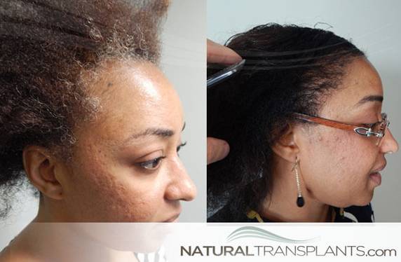 Natural Transplants, Hair Restoration Clinic | 1228 E 7th Ave #200, Tampa, FL 33605, USA | Phone: (813) 440-2598