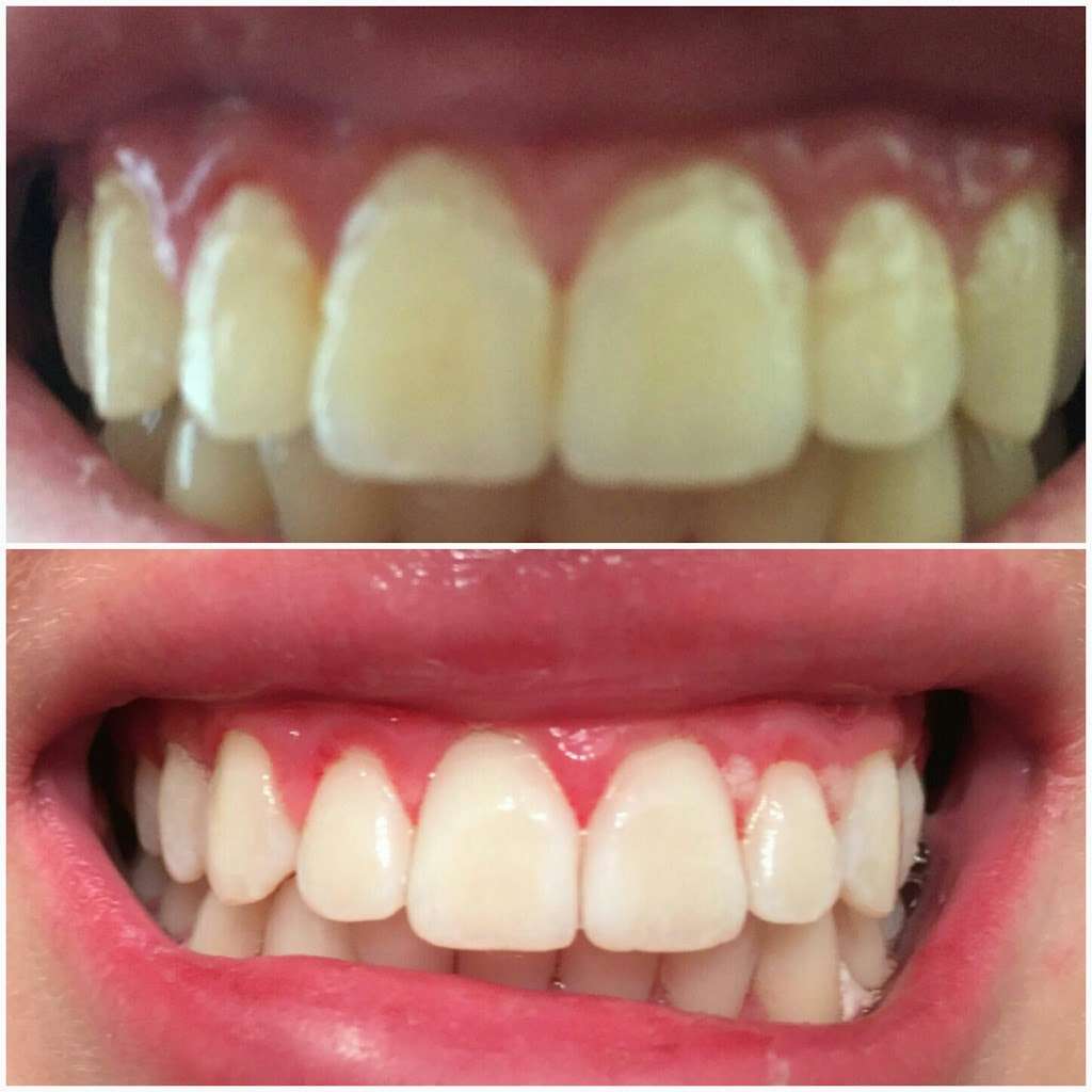 Yevonne’s laser teeth whitening LLC | 4933 S Carson St APT 212, Aurora, CO 80015 | Phone: (720) 629-9030