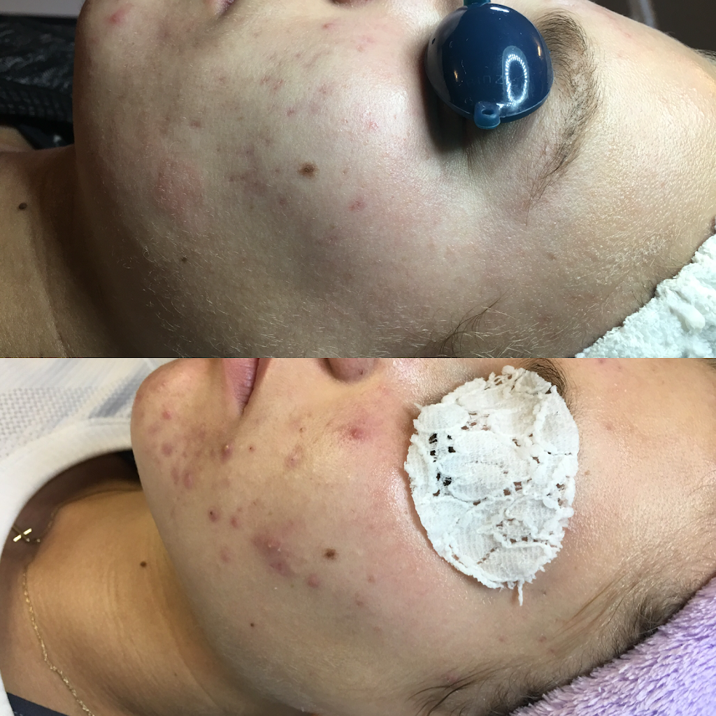 Esthetic Skin by Suzanne | 1501 Bollinger Canyon Rd D, San Ramon, CA 94583, USA | Phone: (925) 263-9590