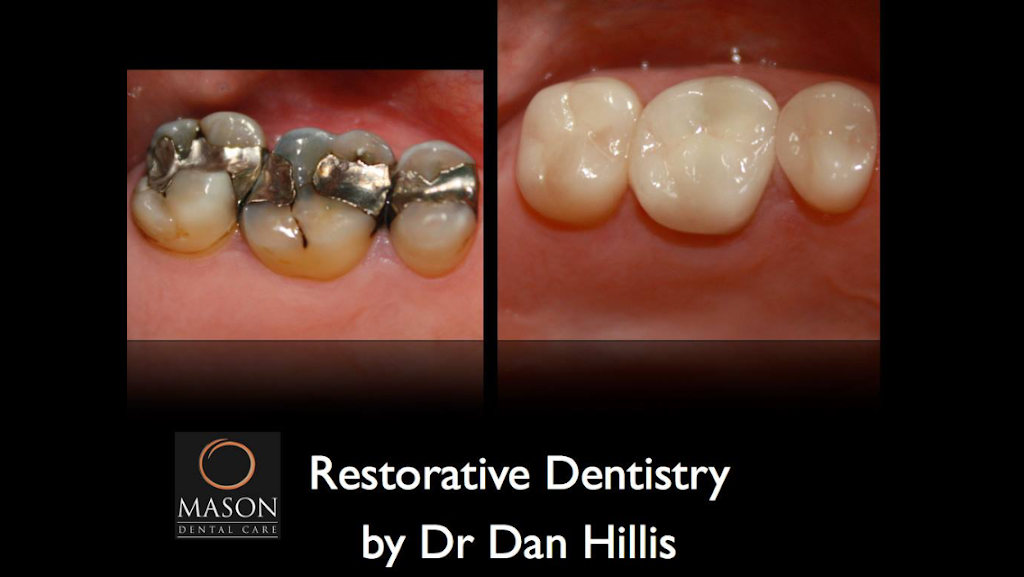 Mason Dental Care, Dr Dan Hillis | 6499 Mason Montgomery Rd, Mason, OH 45040, USA | Phone: (513) 336-8510