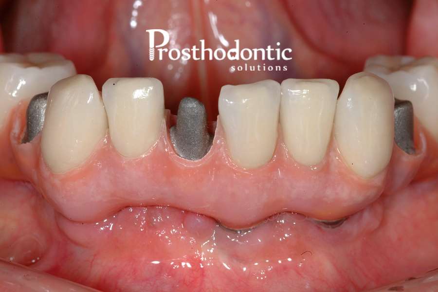 Prosthodontic Solutions-Dr. Michael Waliszewski | 19990 W Greenfield Ave, Brookfield, WI 53045, USA | Phone: (262) 787-0677