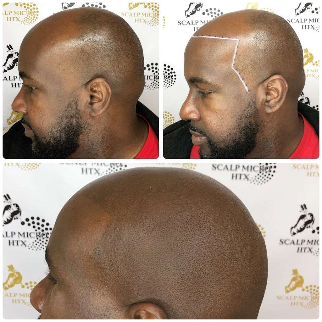 Scalp Micro HTX | 6510 Bellfort St C, Houston, TX 77087, USA | Phone: (832) 303-1722