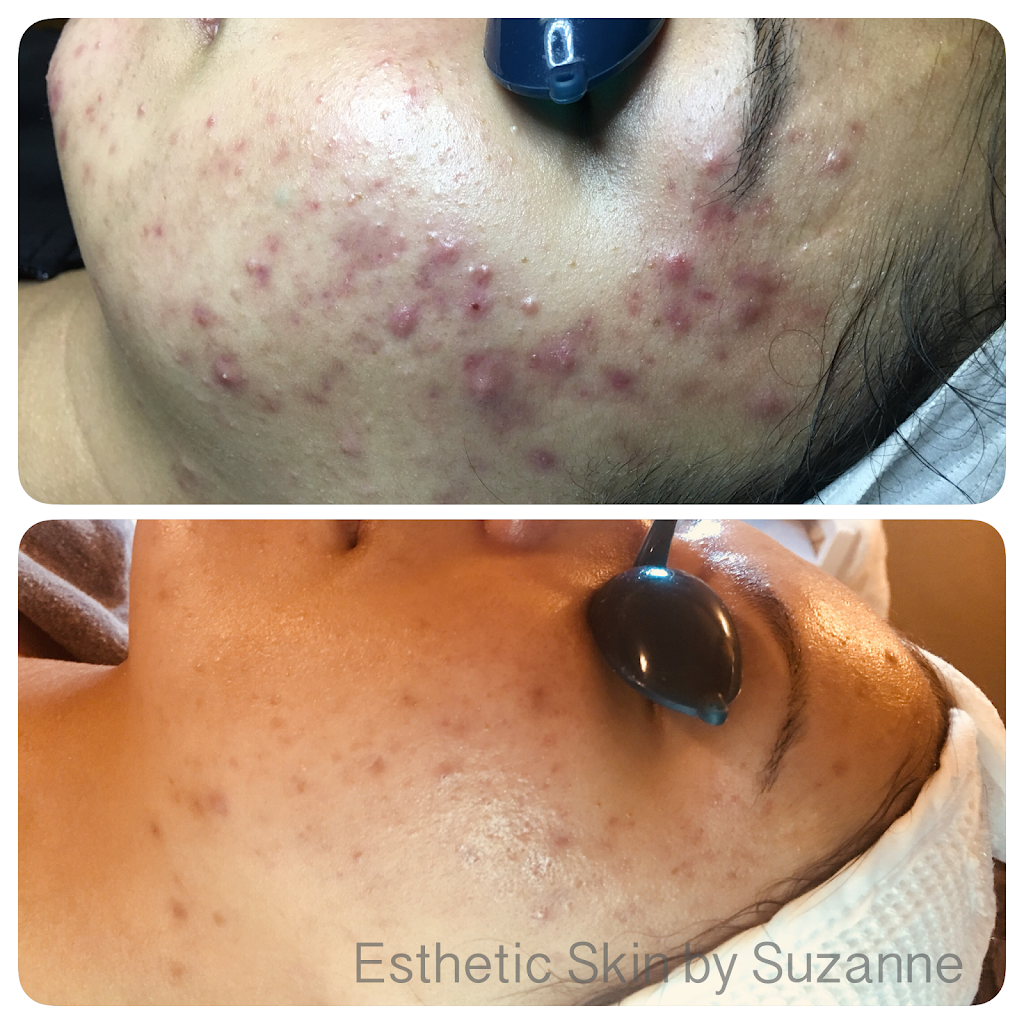 Esthetic Skin by Suzanne | 1501 Bollinger Canyon Rd D, San Ramon, CA 94583, USA | Phone: (925) 263-9590