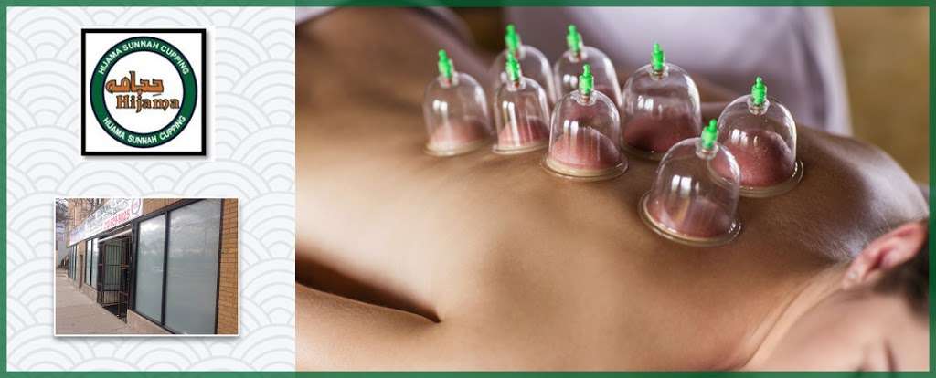 Hijama Sunnah Cupping | 2122 W Devon Ave, Chicago, IL 60659 | Phone: (312) 929-9825