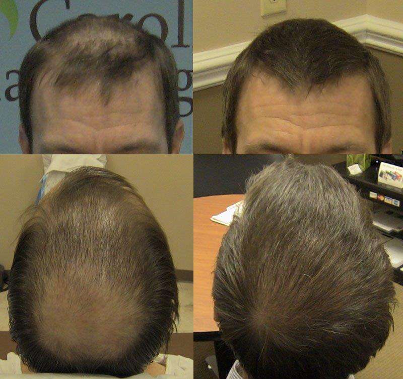 Carolina Hair Surgery: FUE Hair Transplant | 1021 Maxwell Mill Rd, Fort Mill, SC 29708, USA | Phone: (803) 217-3065