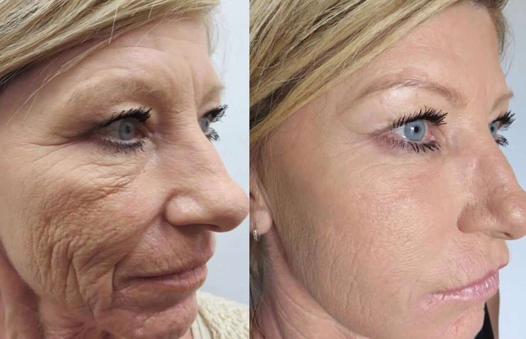 Plasma Skin Lifting NY | 5625 Post Rd #1, The Bronx, NY 10471, USA | Phone: (646) 377-0448