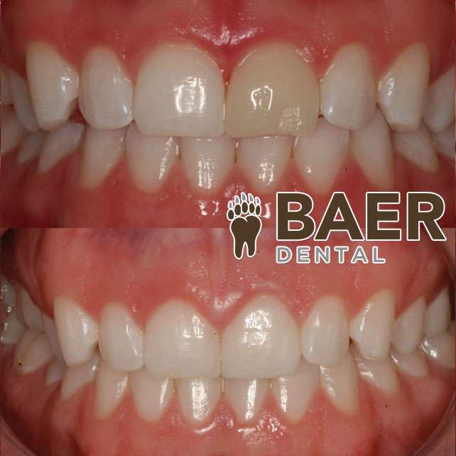 Baer Dental - Aurora | 25521 E Smoky Hill Rd #120, Aurora, CO 80016, USA | Phone: (303) 557-6453