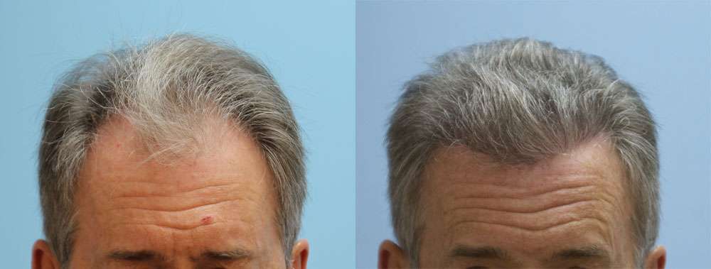 Carolina Hair Surgery: FUE Hair Transplant | 1021 Maxwell Mill Rd, Fort Mill, SC 29708, USA | Phone: (803) 217-3065