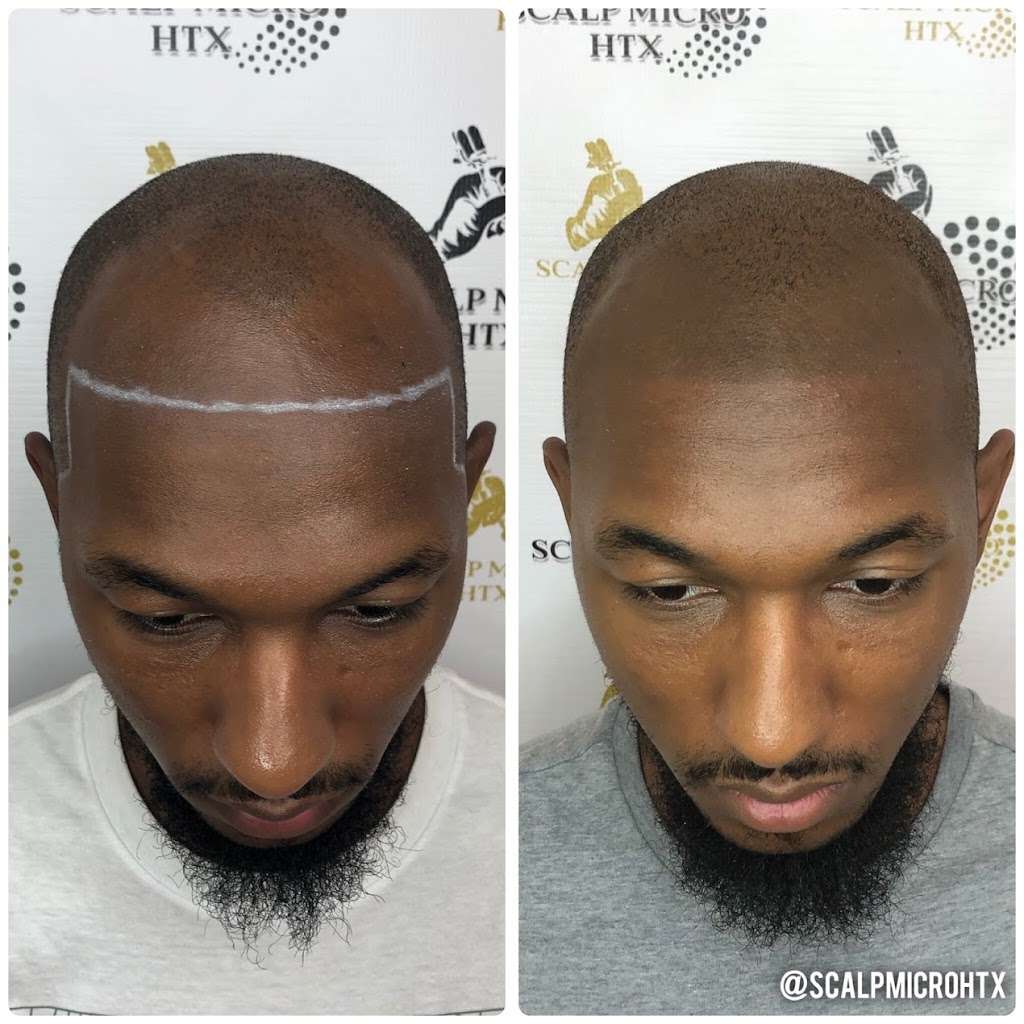 Scalp Micro HTX | 6510 Bellfort St C, Houston, TX 77087, USA | Phone: (832) 303-1722