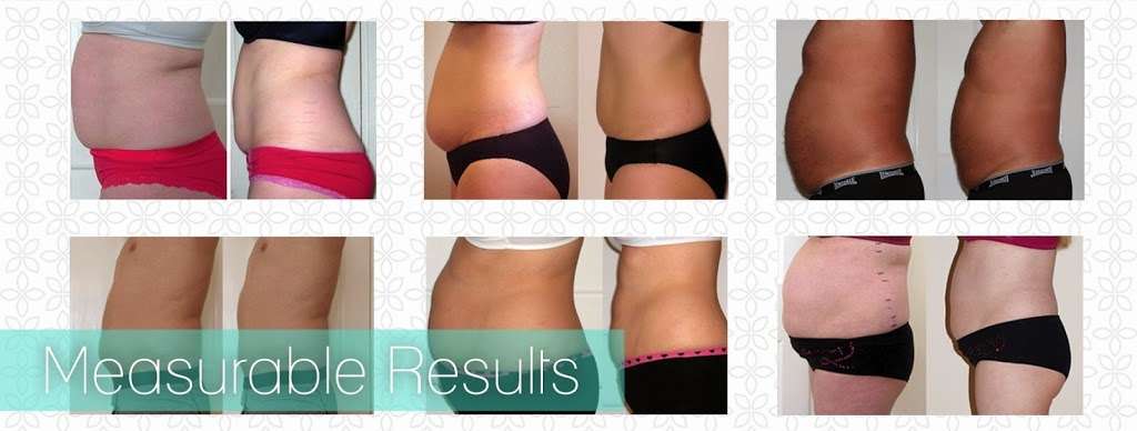 Body by Sage Laser Lipo | 1220 Illicks Mill Rd, Bethlehem, PA 18017, USA | Phone: (610) 865-9961