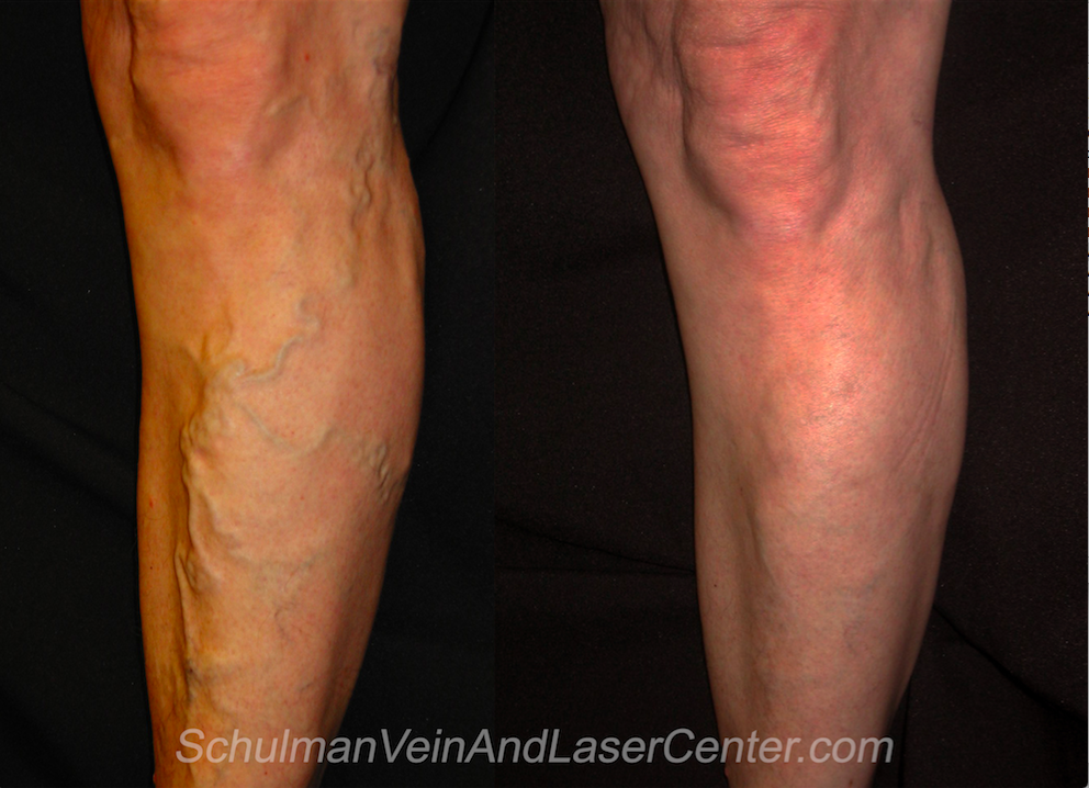 Schulman Vein and Laser Center, Dr. Lee G. Schulman M.D. | 800 Community Dr #211, Manhasset, NY 11030, USA | Phone: (516) 482-4477