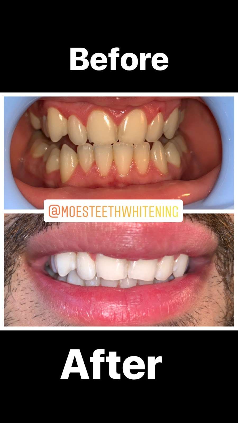 Moes Teeth Whitening | 1530 Jamacha Rd. #X, El Cajon, CA 92019, USA | Phone: (619) 922-1280