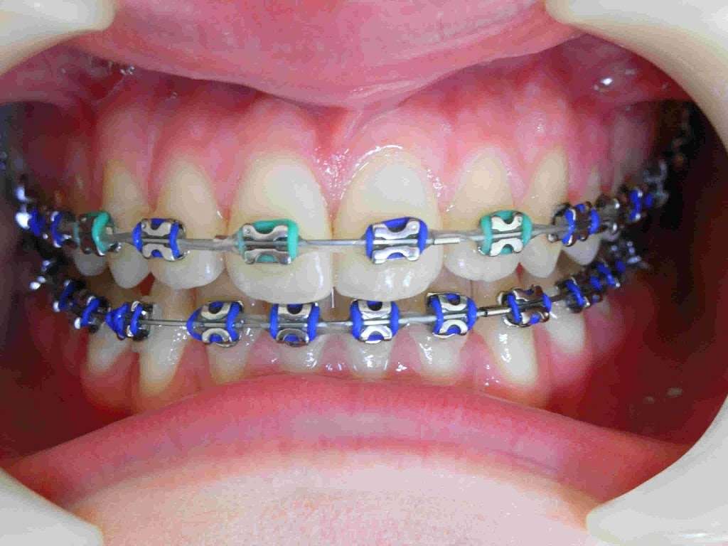 Santelli Orthodontics | 3319 FL-7 #211, Wellington, FL 33449, USA | Phone: (561) 395-6464