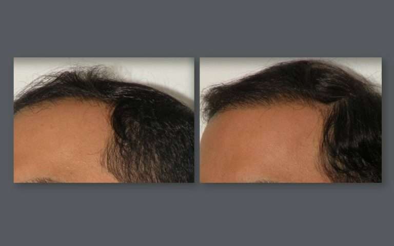 Virginia Hair Transplant | 19440 Golf Vista Plaza #130, Leesburg, VA 20176, USA | Phone: (866) 723-5373