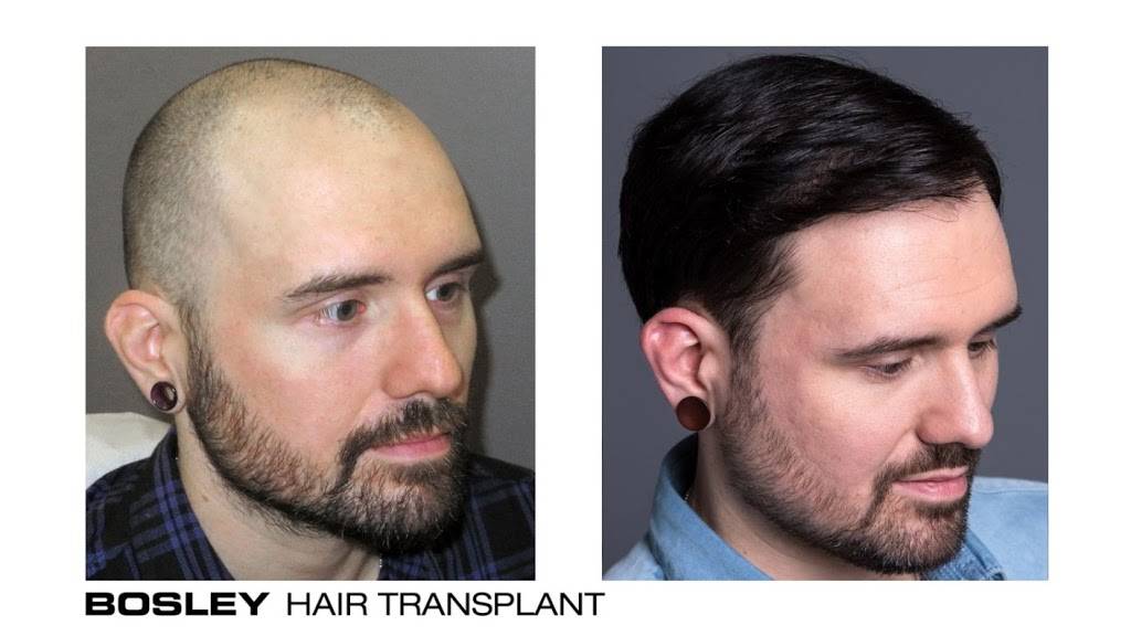Bosley - Hair Restoration & Transplant | 2301 N Parham Rd #1, Richmond, VA 23229, USA | Phone: (804) 238-7358