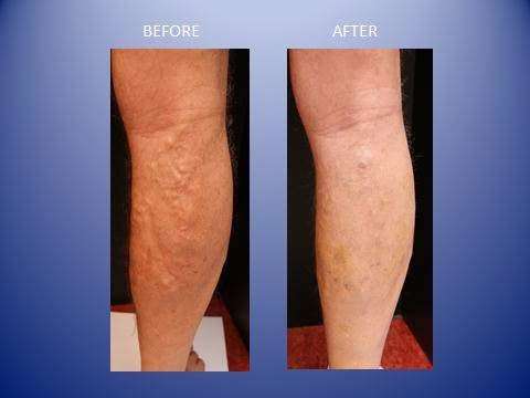 Putnam Westchester Vein Center | 672 Stoneleigh Ave, Carmel Hamlet, NY 10512, USA | Phone: (845) 582-0911