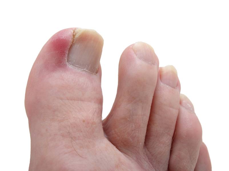 Ingrown Toenail Treatment in Toenail Fungus Treatment Center | 220A St Nicholas Ave, Brooklyn, NY 11237, USA | Phone: (424) 299-4627