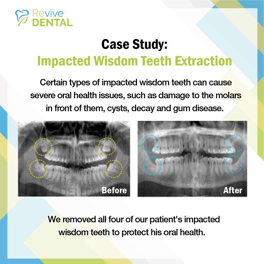 Revive Dental of Irving Family Cosmetic Emergency Implants | 3879 Irving Mall Suite K-2A, Irving, TX 75062, USA | Phone: (214) 574-4867