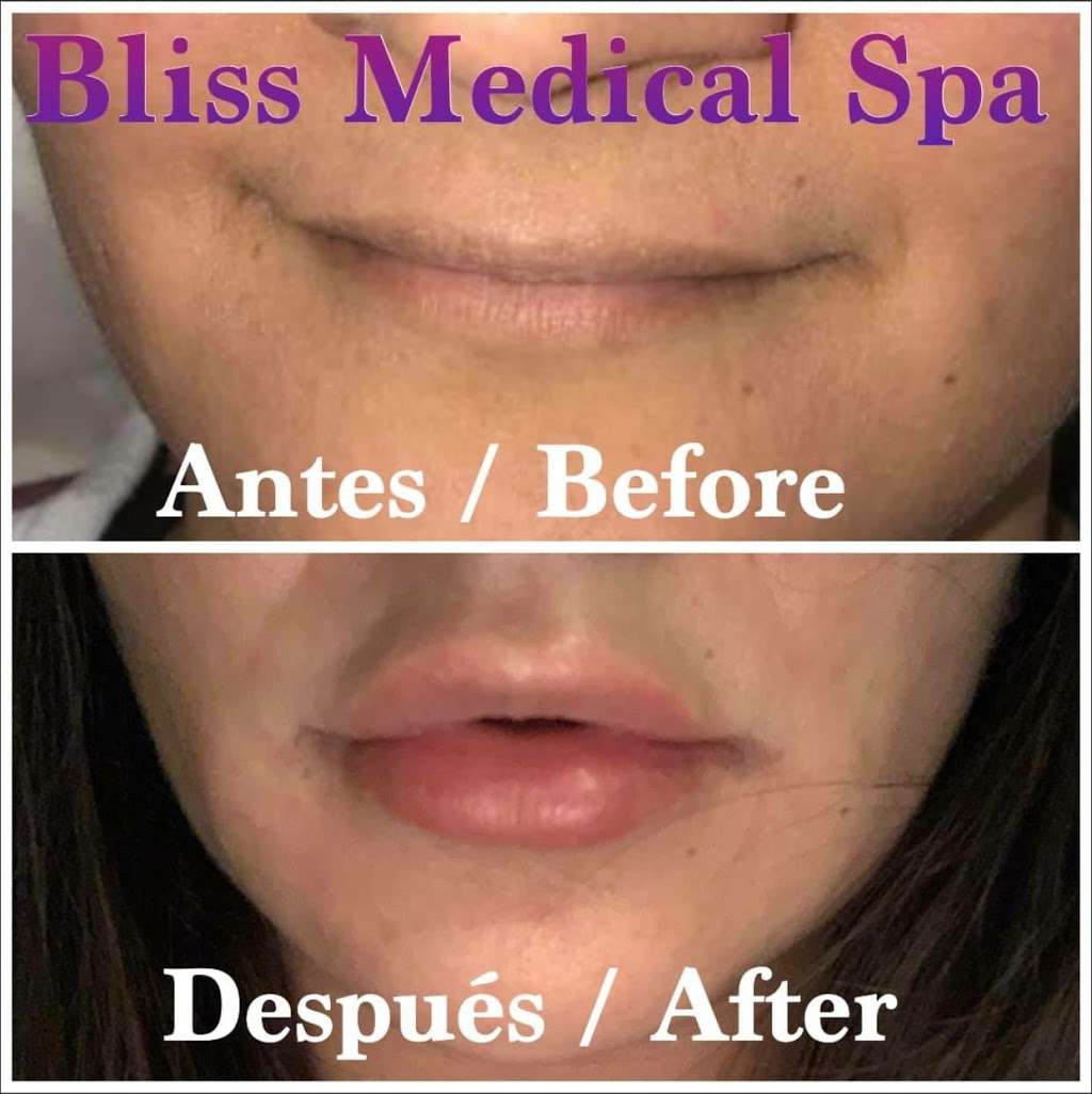 Bliss Medical Spa | 2060 Shadeland Ave Suite 115, Indianapolis, IN 46219, USA | Phone: (786) 877-8827